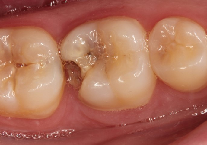 how invisalign works